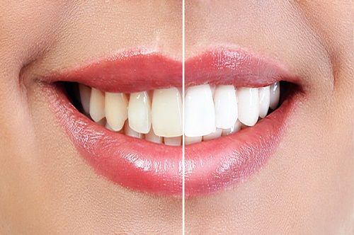 Cosmetic Dentistry - Before & After Tooth Whitening